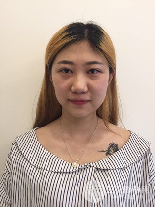 深圳臻希美詳細部自體脂肪填充果對比超明X