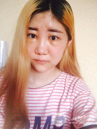 深圳臻希美詳細部自體脂肪填充果對比超明X