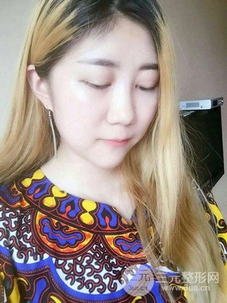 深圳臻希美詳細部自體脂肪填充果對比超明X