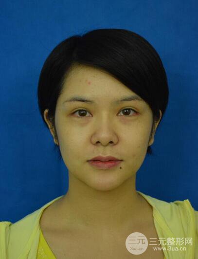 做了隆鼻整形隆鼻之后,短發(fā)女孩也可以性感!