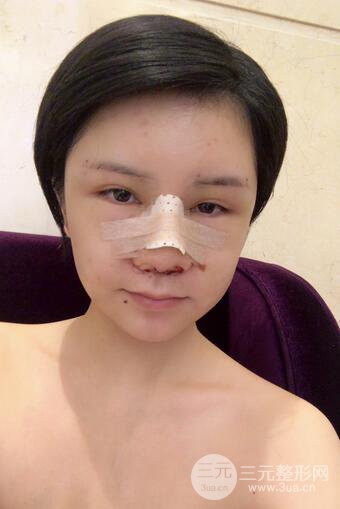 做了隆鼻整形隆鼻之后,短發(fā)女孩也可以性感!