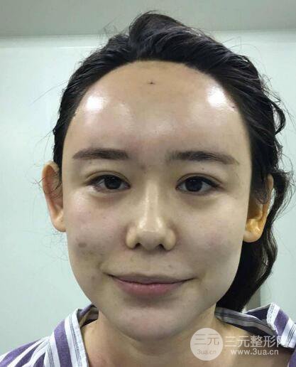 全臉自體脂肪填充,填充不飽滿還可以瘦臉_真人案例