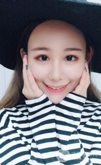 全臉自體脂肪填充,填充不飽滿還可以瘦臉_真人案例