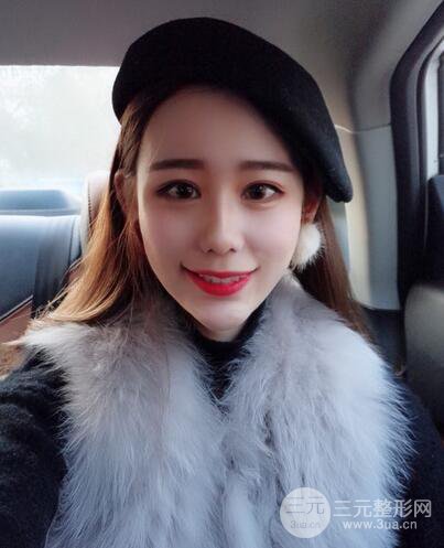 全臉自體脂肪填充,填充不飽滿還可以瘦臉_真人案例