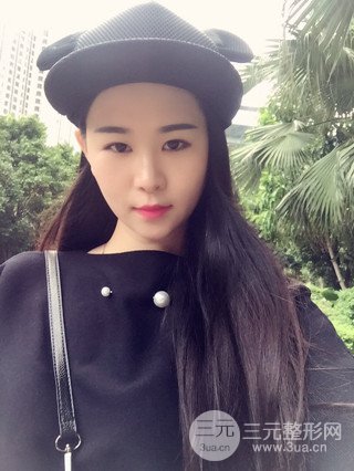 深圳全切雙眼皮修復(fù)成功案例恢復(fù)過(guò)程分享