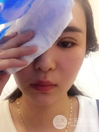 深圳全切雙眼皮修復(fù)成功案例恢復(fù)過(guò)程分享