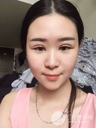 深圳全切雙眼皮修復(fù)成功案例恢復(fù)過(guò)程分享