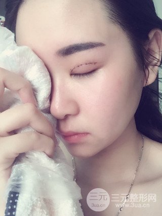 深圳全切雙眼皮修復(fù)成功案例恢復(fù)過(guò)程分享