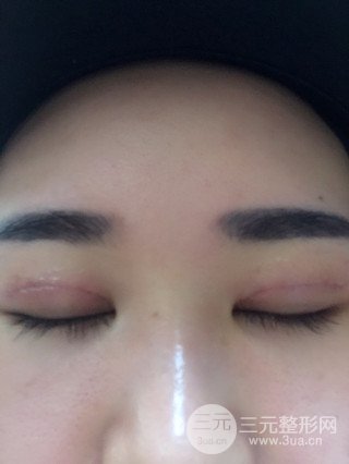深圳全切雙眼皮修復(fù)成功案例恢復(fù)過(guò)程分享