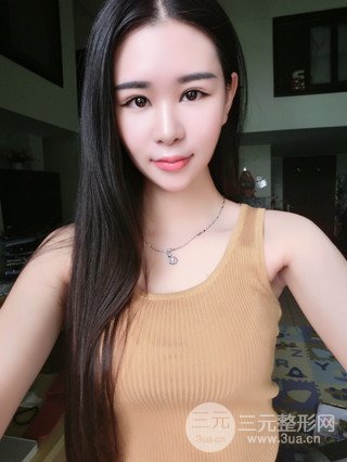 深圳全切雙眼皮修復(fù)成功案例恢復(fù)過(guò)程分享