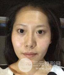 顴骨磨骨改臉型過程和恢復(fù)步驟照片（圖）