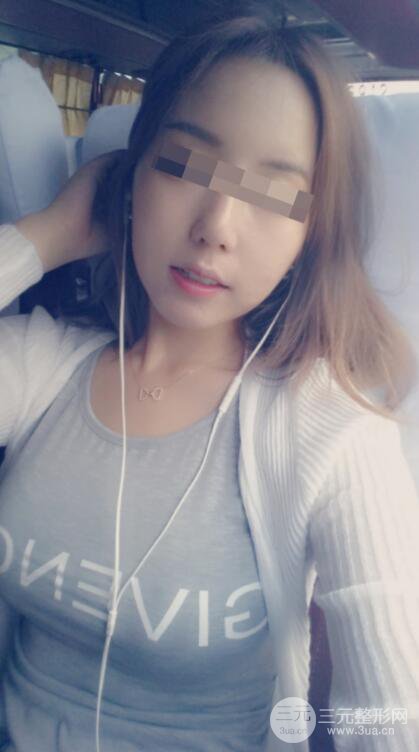 廣東省第二人民醫(yī)院羅盛康假體隆胸前后對比案例