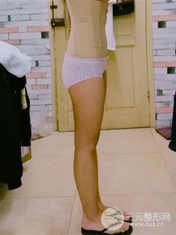 濟(jì)南腰腹吸脂案例三個(gè)月前后變化圖片分享