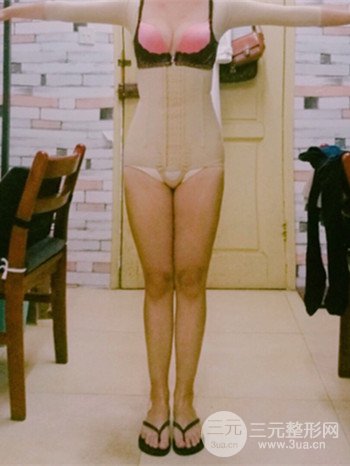 濟(jì)南腰腹吸脂案例三個(gè)月前后變化圖片分享