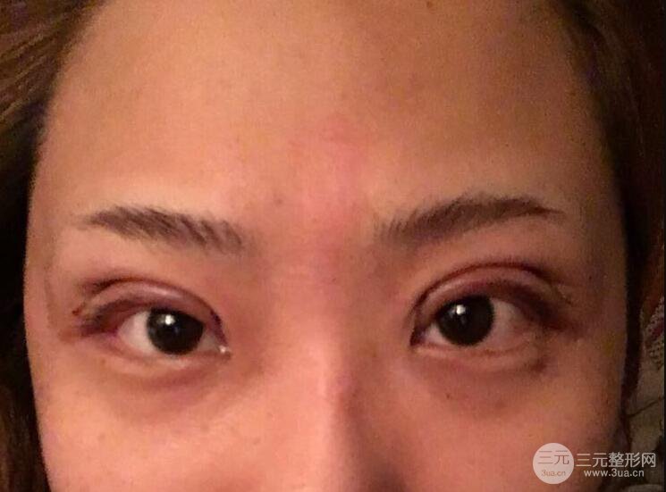 無錫菲尚徐火旺雙眼皮案例