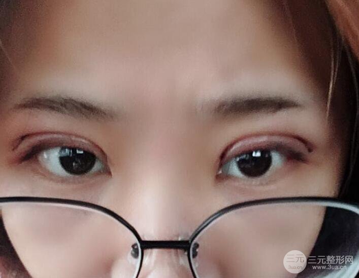 無錫菲尚徐火旺雙眼皮案例