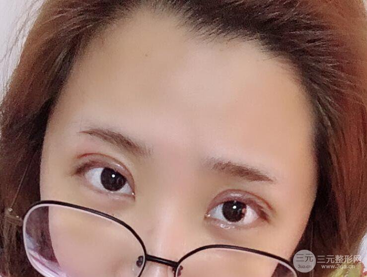 無錫菲尚徐火旺雙眼皮案例