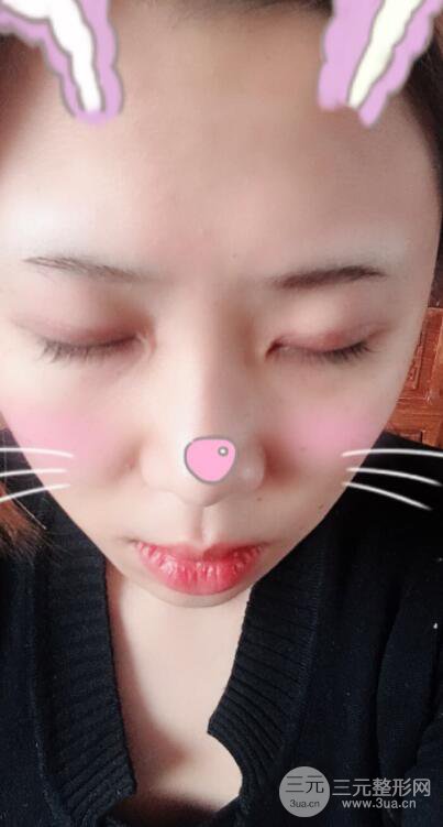 無錫菲尚徐火旺雙眼皮案例