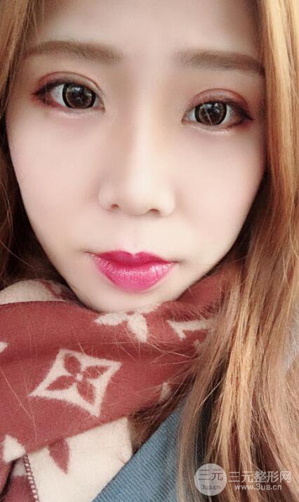 無錫菲尚徐火旺雙眼皮案例