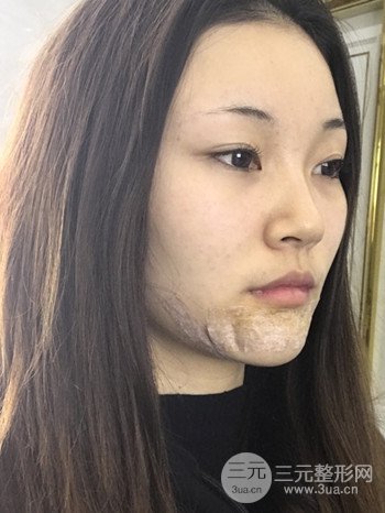 濟(jì)南硅膠假體墊下巴真人案例、下巴改變整個(gè)臉型