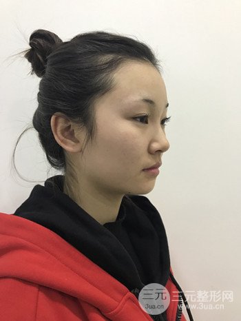 濟(jì)南硅膠假體墊下巴真人案例、下巴改變整個(gè)臉型