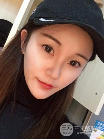 濟(jì)南硅膠假體墊下巴真人案例、下巴改變整個(gè)臉型