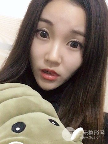 濟(jì)南硅膠假體墊下巴真人案例、下巴改變整個(gè)臉型