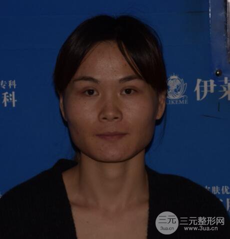 磨骨瘦臉(下頜角切除)恢復(fù)過程及前后對比照片