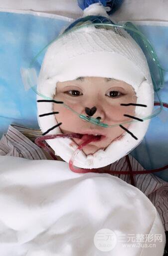 磨骨瘦臉(下頜角切除)恢復(fù)過程及前后對比照片