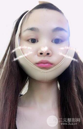 磨骨瘦臉(下頜角切除)恢復(fù)過程及前后對比照片