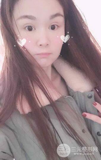 磨骨瘦臉(下頜角切除)恢復(fù)過程及前后對比照片