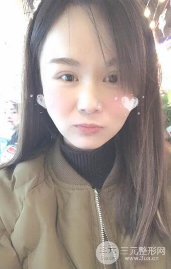 磨骨瘦臉(下頜角切除)恢復(fù)過程及前后對比照片