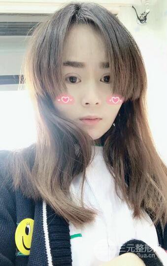 磨骨瘦臉(下頜角切除)恢復(fù)過程及前后對比照片