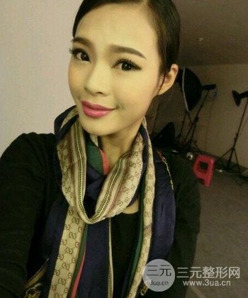 模特做隆鼻整形真實日記分享，附上恢復(fù)過程圖