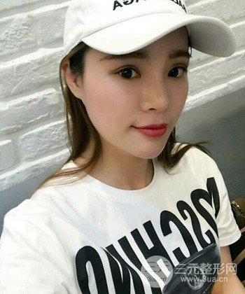 模特做隆鼻整形真實日記分享，附上恢復(fù)過程圖