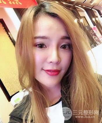 模特做隆鼻整形真實日記分享，附上恢復(fù)過程圖