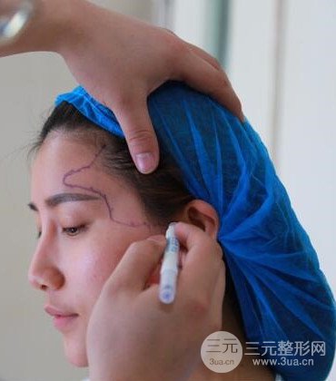 網(wǎng)絡(luò)主播做自體脂肪豐太陽穴真實案例分享，果杠杠的