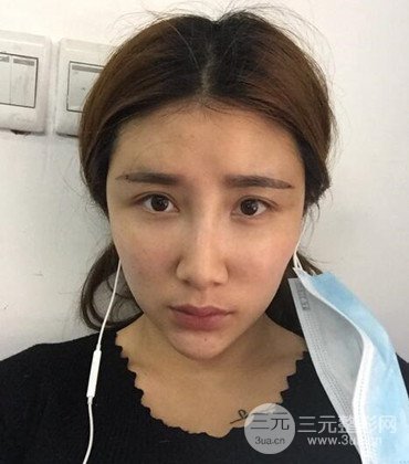 網(wǎng)絡(luò)主播做自體脂肪豐太陽穴真實案例分享，果杠杠的