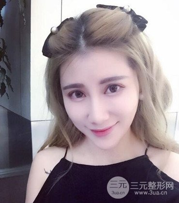 網(wǎng)絡(luò)主播做自體脂肪豐太陽穴真實案例分享，果杠杠的