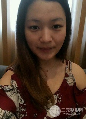 深圳雙眼皮正就內(nèi)雙小眼睛，真實(shí)案例前后對比照片