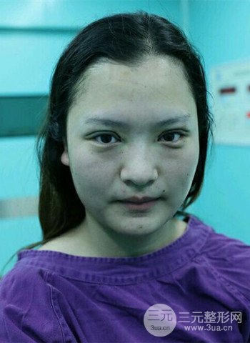 深圳雙眼皮正就內(nèi)雙小眼睛，真實(shí)案例前后對比照片
