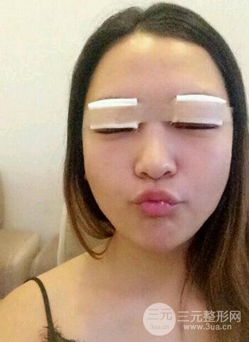 深圳雙眼皮正就內(nèi)雙小眼睛，真實(shí)案例前后對比照片