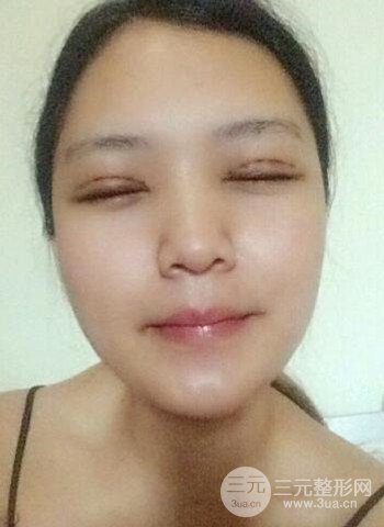 深圳雙眼皮正就內(nèi)雙小眼睛，真實(shí)案例前后對比照片
