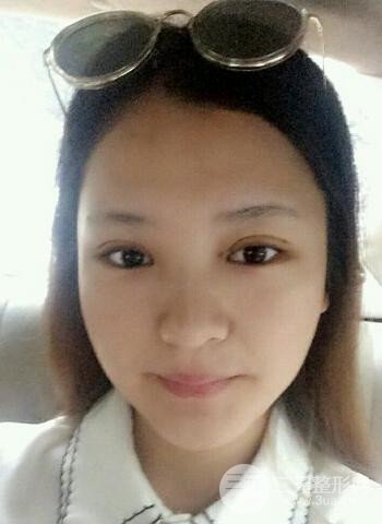 深圳雙眼皮正就內(nèi)雙小眼睛，真實(shí)案例前后對比照片