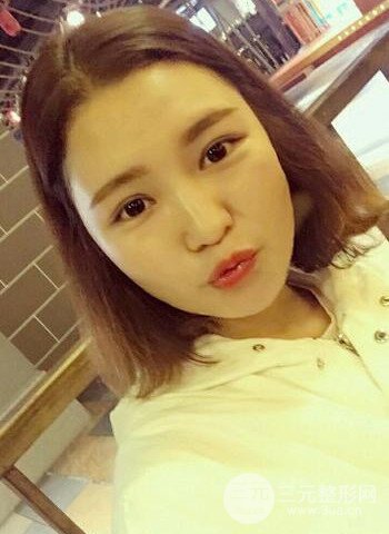 深圳雙眼皮正就內(nèi)雙小眼睛，真實(shí)案例前后對比照片