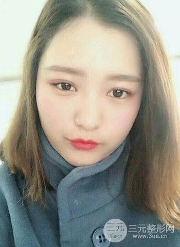 深圳雙眼皮正就內(nèi)雙小眼睛，真實(shí)案例前后對比照片
