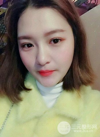 深圳雙眼皮正就內(nèi)雙小眼睛，真實(shí)案例前后對比照片