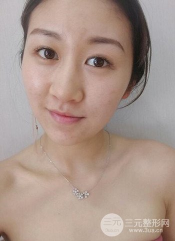 廣州隆鼻整形真實恢復(fù)期圖片,擁有精致美鼻不是夢