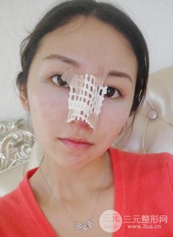 廣州隆鼻整形真實恢復(fù)期圖片,擁有精致美鼻不是夢
