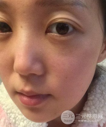 深圳內(nèi)切去眼袋+硅膠墊下巴真實(shí)案例恢復(fù)果圖